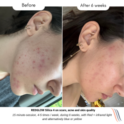 Silica 4 LED Mask Antiaging und Akne| Medi-Lum