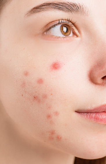 Acné : Symptômes & traitements contre l'acné du visage | Medi-Lum